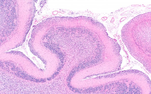 2B5 Medulloblastoma (Case 2) N15 H&E 4X