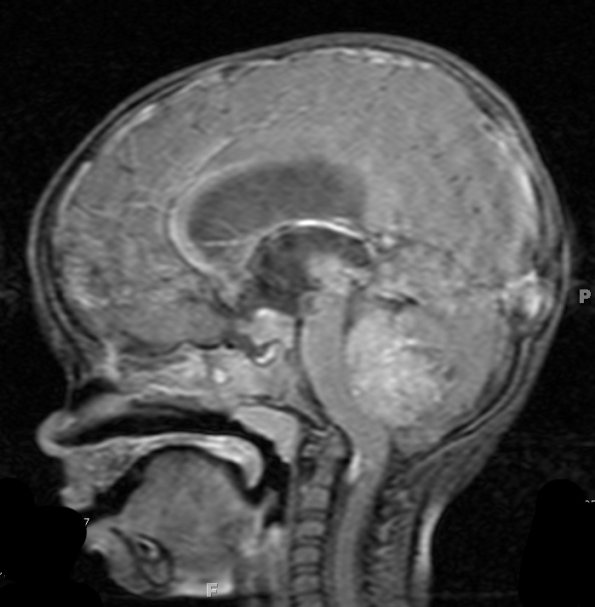4A Medulloblastoma (Case 4) T1 W 3 - Copy - Copy