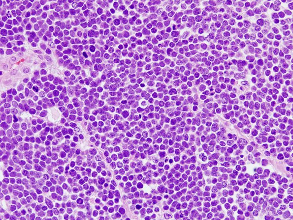 4B1 Medulloblastoma (Case 4) H&E 3.jpg