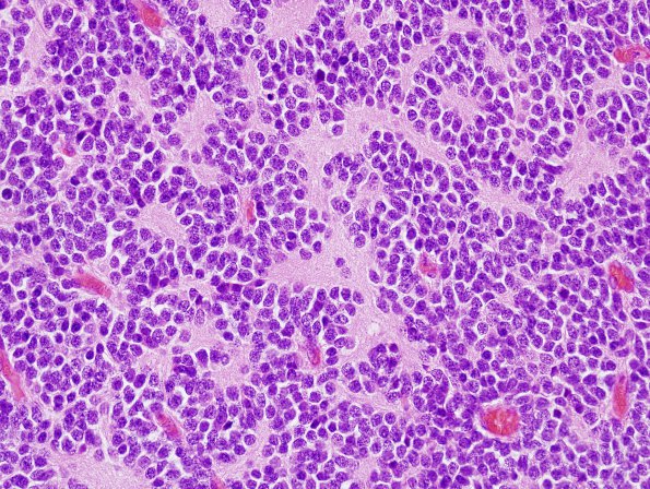 4B2 Medulloblastoma (Case 4) H&E 1.jpg