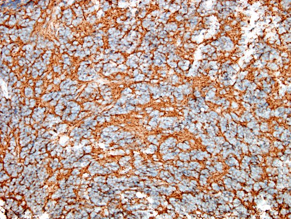 4C1 Medulloblastoma (Case 4) SYN 3.jpg