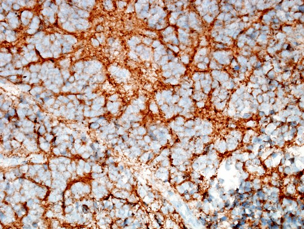 4C2 Medulloblastoma (Case 4) SYN 2.jpg