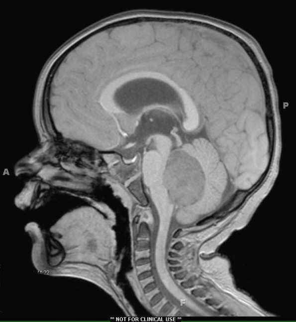 5A1 Medulloblastoma, classical (Case 5) T1 1 - Copy