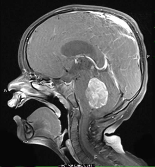 5A2 Medulloblastoma, classical (Case 5) T1 W 1 - Copy