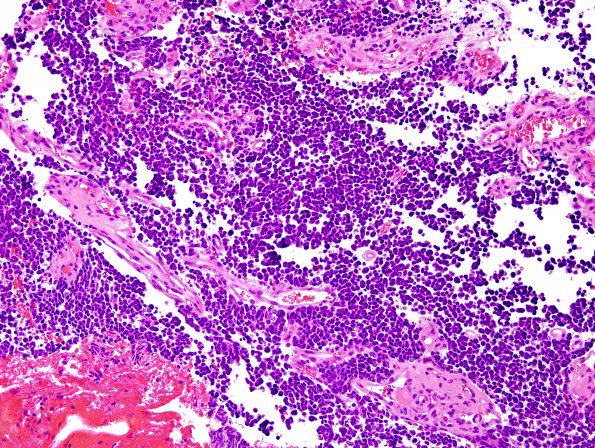 5B2 Medulloblastoma, classical (Case 5) H&E 3