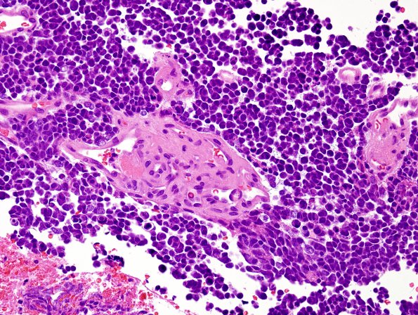 5B3 Medulloblastoma, classical (Case 5) H&E 1