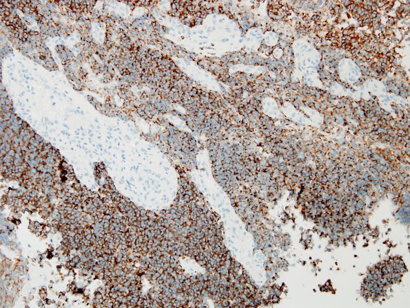 5C1 Medulloblastoma, classical (Case 5) SYN 2