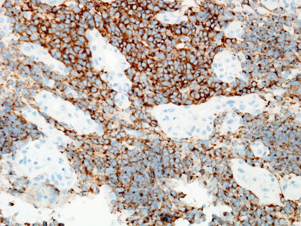 5C2 Medulloblastoma, classical (Case 5) SYN 4