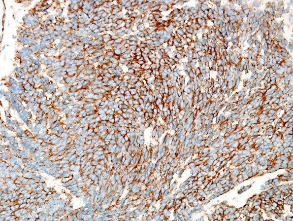 5D1 Medulloblastoma, classical (Case 5) b-Catenin 1