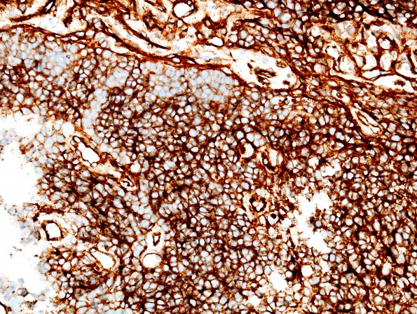 5D2 Medulloblastoma, classical (Case 5) b-Catenin 2