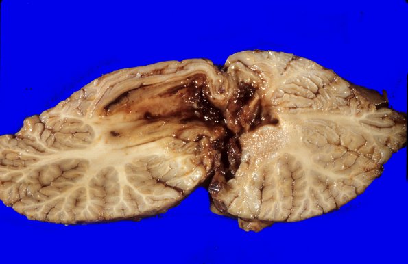 6 A1 Medulloblastoma (Case 6) 5