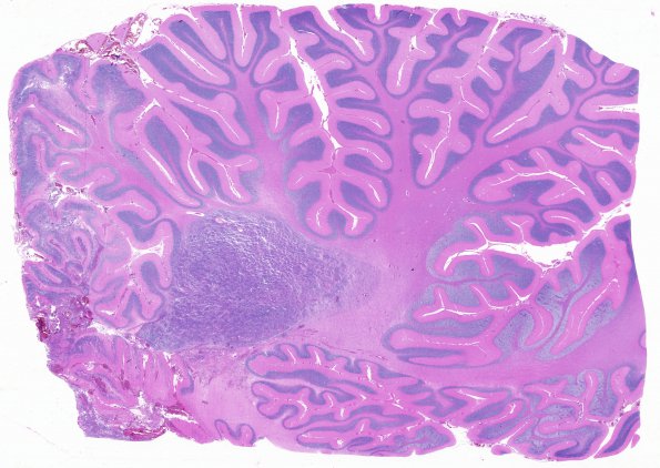 6B1 Medulloblastoma (Case 6) H&E WM