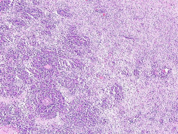 6B2 Medulloblastoma (Case 6) H&E 1