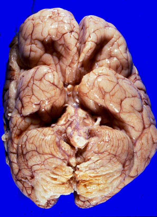 7A1 Medulloblastoma (Case 7) 7 - Copy