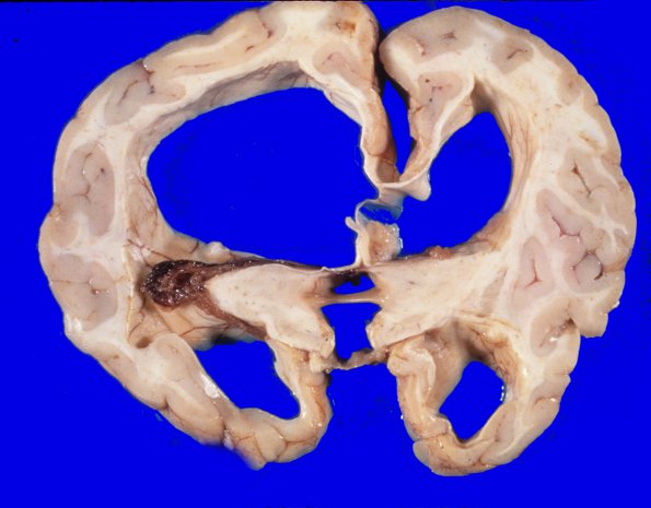 7A2 Medulloblastoma (Case 7) 4 - Copy