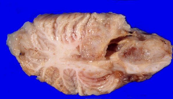 7A3 Medulloblastoma (Case 7) 5 - Copy