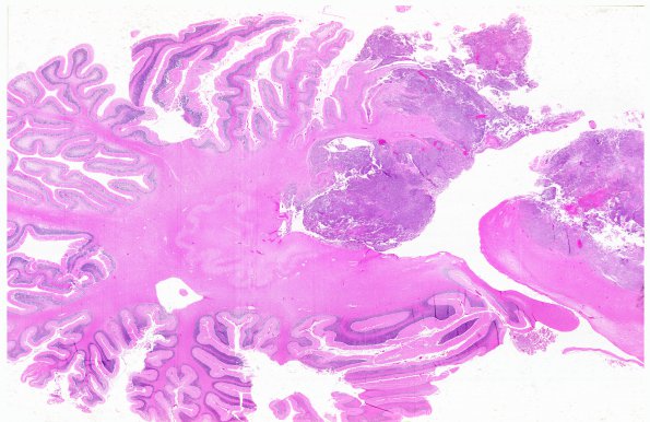 7A3A Medulloblastoma (Case 7) G