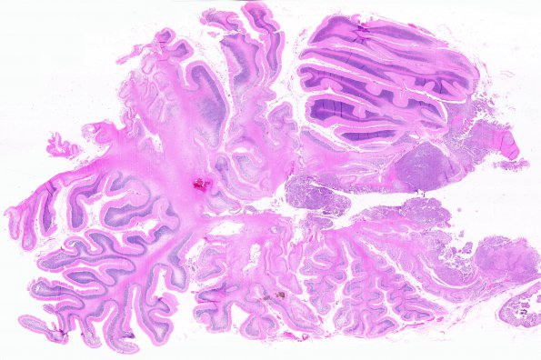 7A3B Medulloblastoma (Case 7) K WM