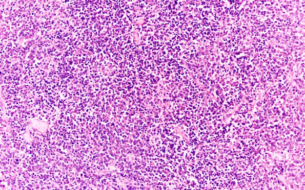 7A3C Medulloblastoma (Case 7) M 20X