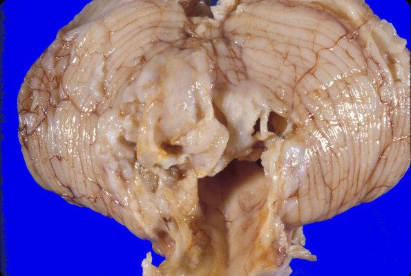 7A4 Medulloblastoma (Case 7) 6 - Copy