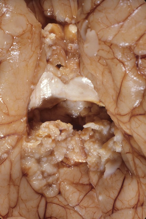 7A5 Medulloblastoma (Case 7) 8 - Copy