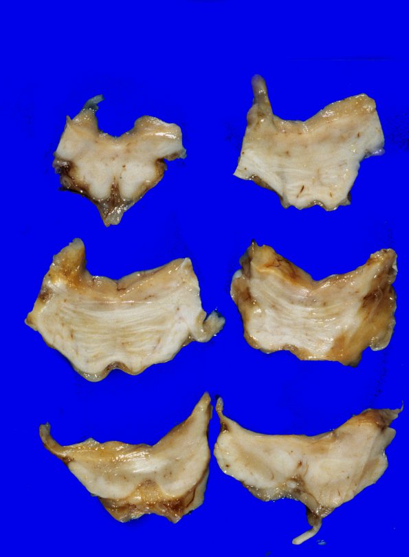 7A6 Medulloblastoma (Case 7) 1
