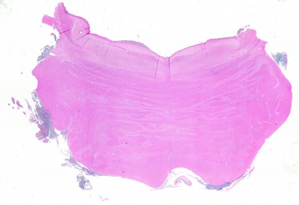 7A6 Medulloblastoma (Case 7) E - Copy