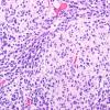 8B2 Medulloblastoma with nodular areas (Case 8)-H&E-1