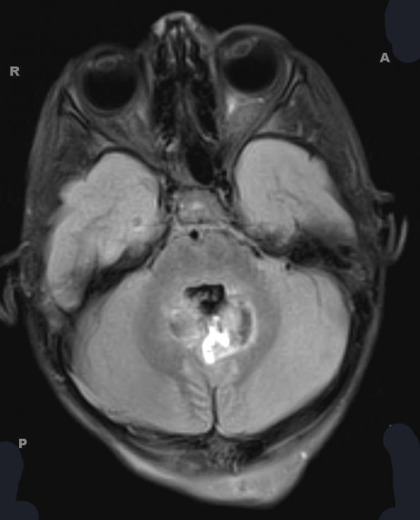 9A1 Medulloblastoma (Case 9) FLAIR 1 - Copy