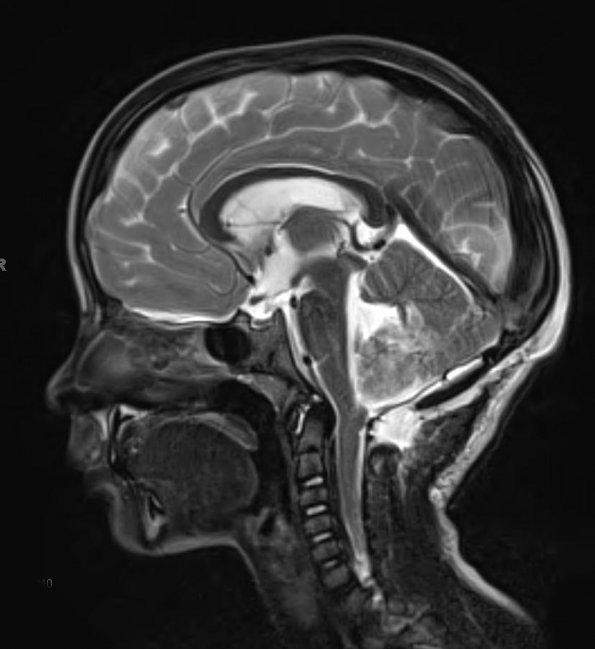 9A3 Medulloblastoma (Case 9) MRI 3 - Copy