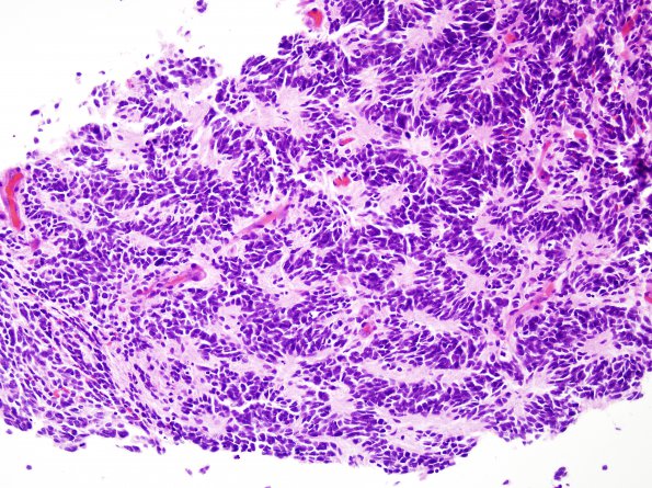 9B1 Medulloblastoma (Case 9) H&E 3