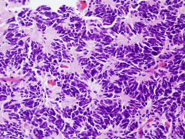 9B2 Medulloblastoma (Case 9) Homer-Wright H&E 6