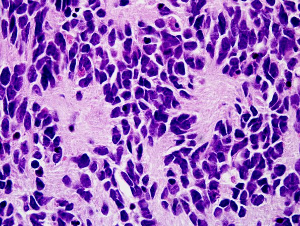 9B3 Medulloblastoma (Case 9) Homer-Wright H&E 1