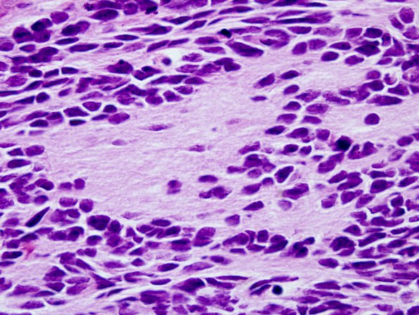 9B4 Medulloblastoma (Case 9) Homer-Wright H&E 7