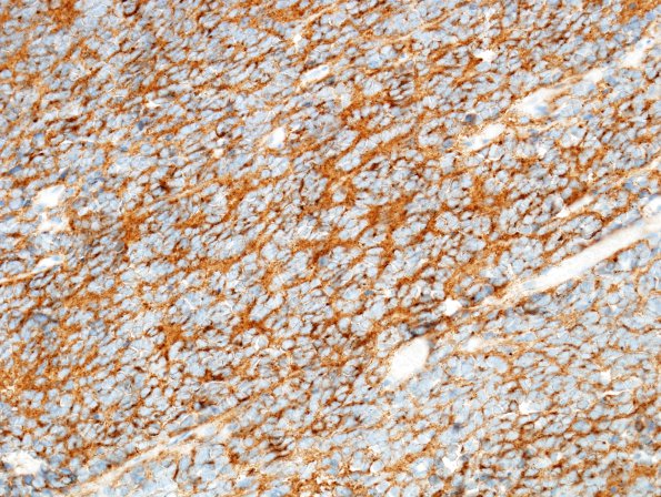 9C Medulloblastoma (Case 9) SYN 1