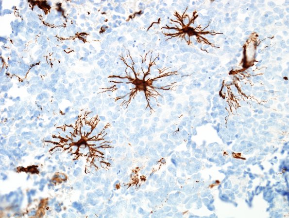 9D Medulloblastoma (Case 9) GFAP 2