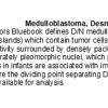 0A Desmoplastic Medulloblastoma (DN)