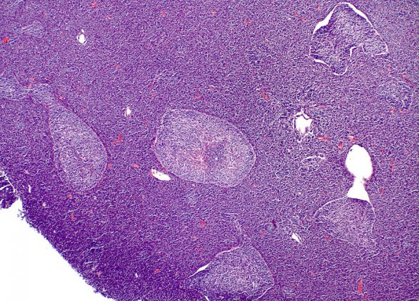 1A1 Medulloblastoma, Desmoplastic (Case 1) 1