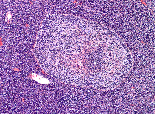 1A2 Medulloblastoma, Desmoplastic (Case 1) 2