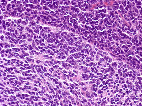 1A3 Medulloblastoma, Desmoplastic (Case 1) 5