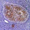 1B1 Medulloblastoma, Desmoplastic (Case 1) SYN 1