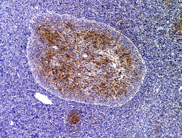 1B1 Medulloblastoma, Desmoplastic (Case 1) SYN 1