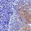 1B2 Medulloblastoma, Desmoplastic (Case 1) SYN 4