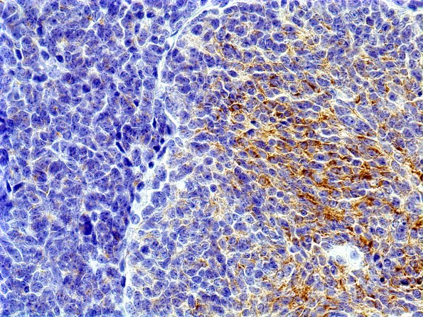 1B2 Medulloblastoma, Desmoplastic (Case 1) SYN 4