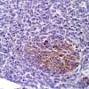 1B3 Medulloblastoma, Desmoplastic (Case 1) SYN 2