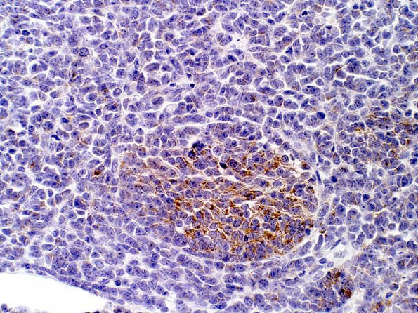 1B3 Medulloblastoma, Desmoplastic (Case 1) SYN 2