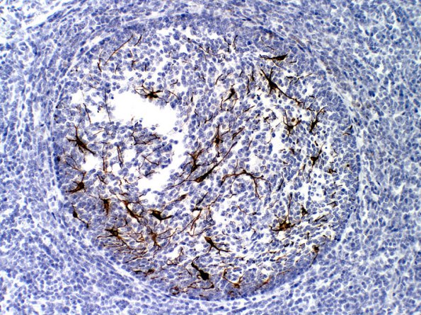 1C1 Medulloblastoma, Desmoplastic (Case 1) GFAP 2