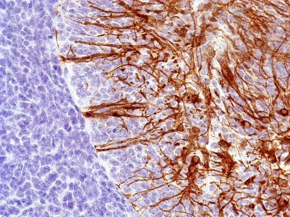 1C3 Medulloblastoma, Desmoplastic (Case 1) GFAP 4