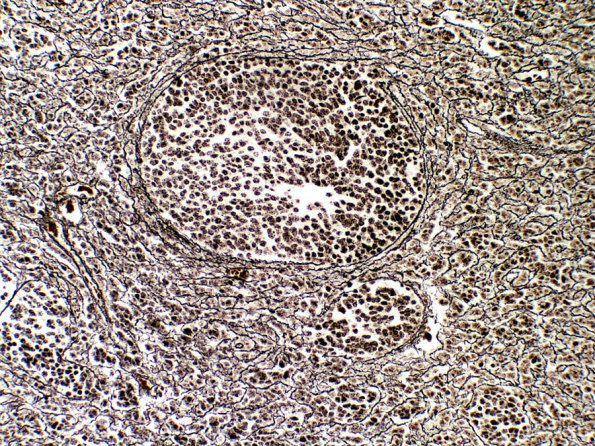 1D1 Medulloblastoma, Desmoplastic (Case 1) Retic 2