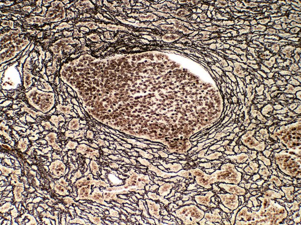 1D2 Medulloblastoma, Desmoplastic (Case 1) Retic 1